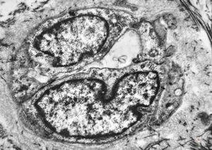 F,42y. | pseudoangiomatous hyperplasia